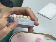 Coronas cerámicas translúcidas para la restauración dental con estética natural y fácil limpieza
