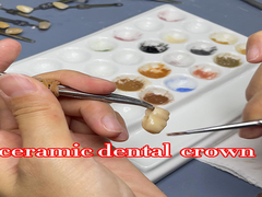 Corona dental de zirconia de aspecto natural translúcida con excelente durabilidad y ajuste preciso