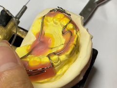 Aplicación de ortodoncia hecha a medida con buena retención y características ajustables