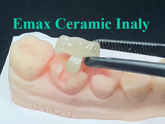La incrustación Emax Ceramic que está hecha a medida precisamente para su posición designada