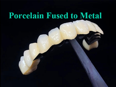 Porcelana fundida con corona de metal que combina durabilidad y belleza para la salud dental