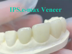 EMAX Veneer La solución ideal para restauraciones dentales duraderas y estéticas