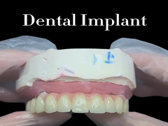 Los implantes dentales son la solución ideal para reemplazar los dientes perdidos y restablecer la sonrisa