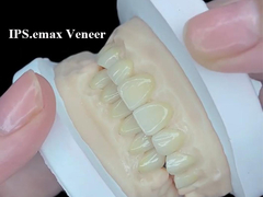 IPS.emax Veneer Solución estética premium para transformaciones de sonrisa impresionantes