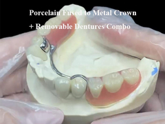 Porcelana fundida a la corona de metal más dentaduras parciales extraíbles combinadas