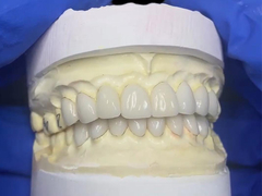 Carillas de porcelana IPS EMAX para restauraciones de dientes frontales de aspecto natural