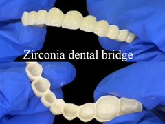 Puente dental de zirconia Restauración de aspecto fuerte y natural para una sonrisa perfecta