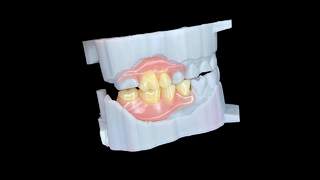 Dentaduras postizas flexibles personalizadas con un ajuste natural y comodidad duradera.