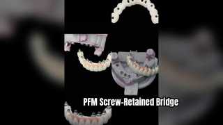 Restauración de implantes atornillados de precisión PFM
