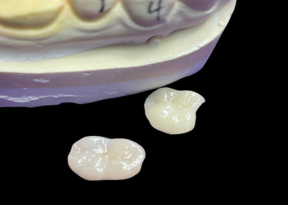 comprar IPS e.max Inlays y onlays cerámicos para la restauración molar Estética natural y durabilidad superior para resultados duraderos online manufacture