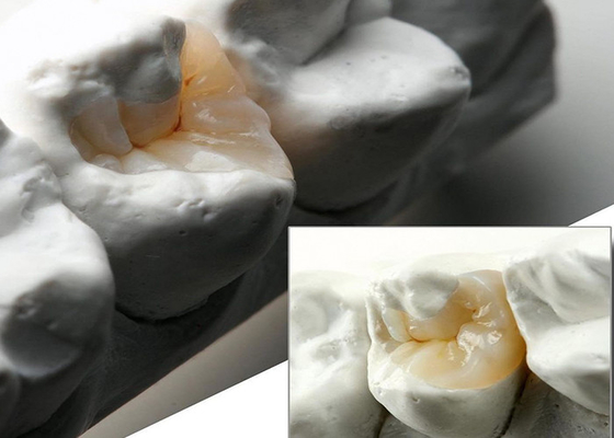 comprar Inlays y onlays cerámicos de aspecto natural para restauración dental precisa de nuestro laboratorio dental experto online manufacture