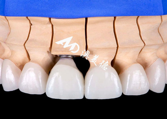 comprar Biocompatible base de aleación de titanio implantes dentales puente corona con aspecto natural online manufacture