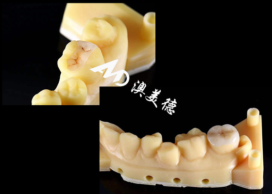 comprar Inlays y onlays cerámicos de precisión para la reparación de dientes con color natural material hipoalergénico y ajuste sin costuras para una comodidad y durabilidad superiores online manufacture