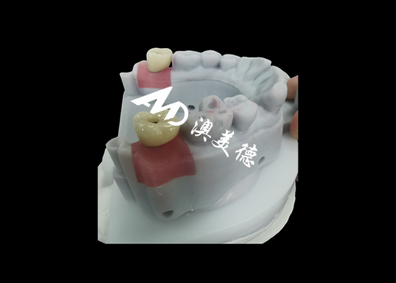 comprar Corona de implantes dentales con pilar de titanio para restauración dental duradera online manufacture