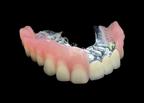 comprar Mejora tu sonrisa Puente de corona PFM de aspecto natural y dentaduras removibles Combinación online manufacture