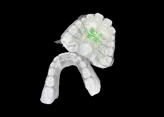 comprar Expansión ortodóntica extraíble eficaz para una alineación óptima de la mandíbula y la salud dental online manufacture