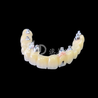 comprar Puente de implante atornillado de porcelana fusionada a metal (PFM) online manufacture