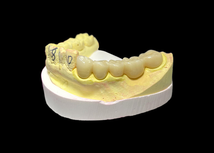 Corona dental de porcelana de zirconio de primera calidad Fuerza inigualable Precisión de ajuste y estética y durabilidad excepcionales