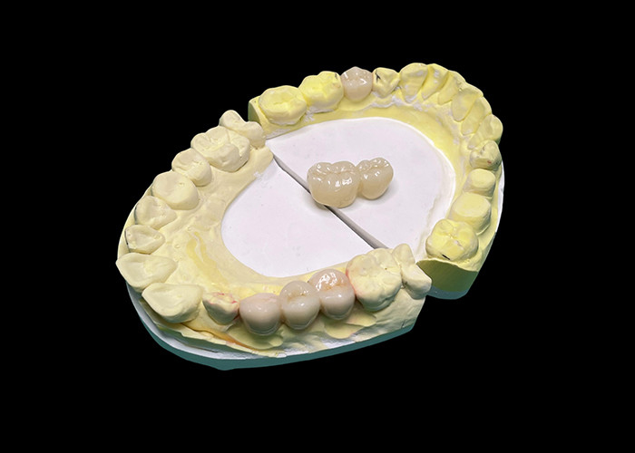 Coronas y puentes de cerámica de translucidez avanzada mejoran su sonrisa con precisión y estética natural para una durabilidad duradera