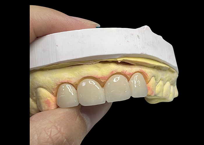 Coronas y puentes de cerámica de translucidez avanzada mejoran su sonrisa con precisión y estética natural para una durabilidad duradera
