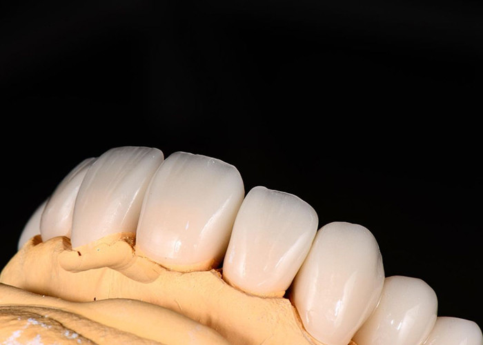 Coronas y puentes de cerámica de translucidez avanzada mejoran su sonrisa con precisión y estética natural para una durabilidad duradera