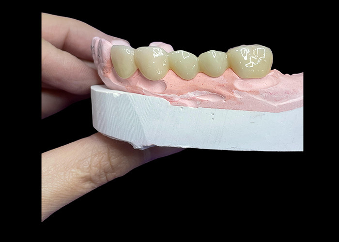Todas las coronas y puentes de cerámica diseñadas para una estética superior, durabilidad y ajuste natural para una confianza duradera