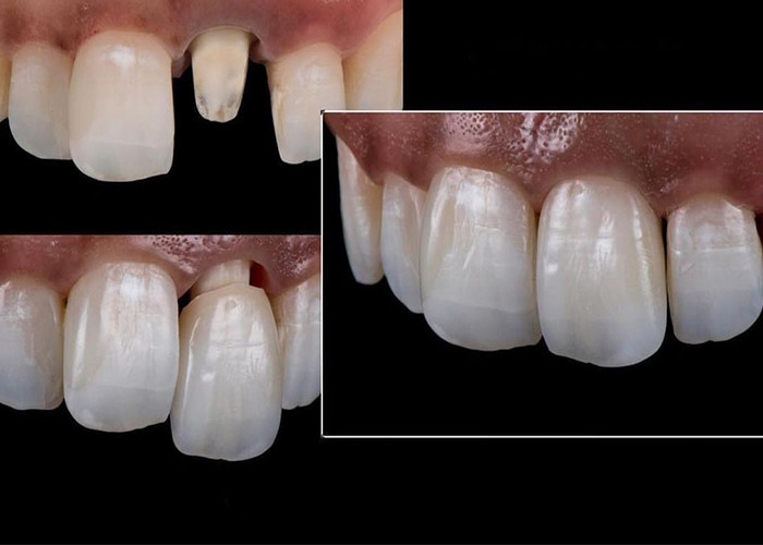 Todas las coronas y puentes de cerámica diseñadas para una estética superior, durabilidad y ajuste natural para una confianza duradera