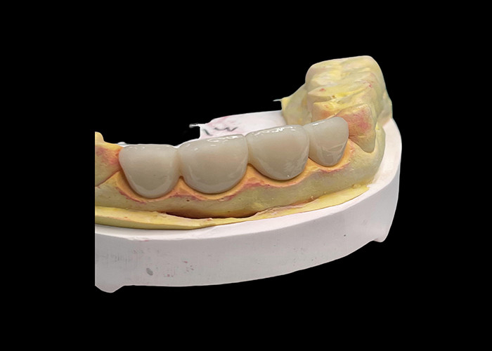 Puente de corona de cerámica con excelente biocompatibilidad para la restauración dental