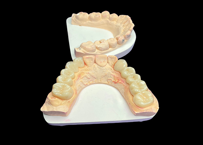 Coronas de cerámica translúcidas para la restauración dental con limpieza fácil y resultados duraderos