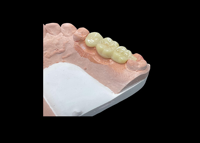 Coronas de cerámica translúcidas para la restauración dental con limpieza fácil y resultados duraderos