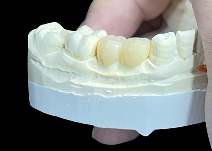 Coronas y puentes de cerámica personalizadas para un ajuste perfecto y un rendimiento duradero
