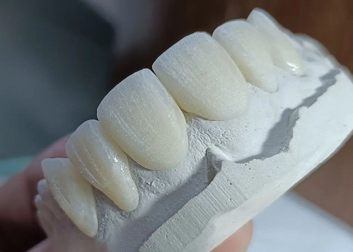 Puente de corona de cerámica resistente al desgaste para una restauración dental cómoda y precisa