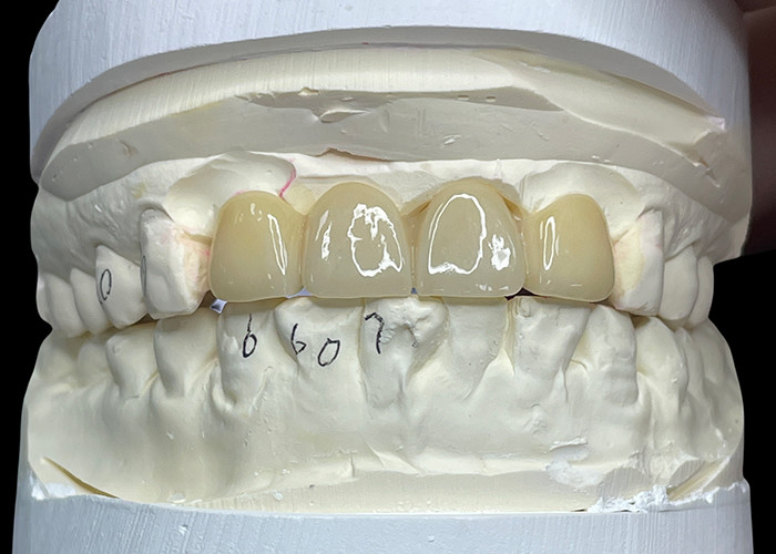 Resistente a las manchas Puente de porcelana confortable adecuado para la restauración dental