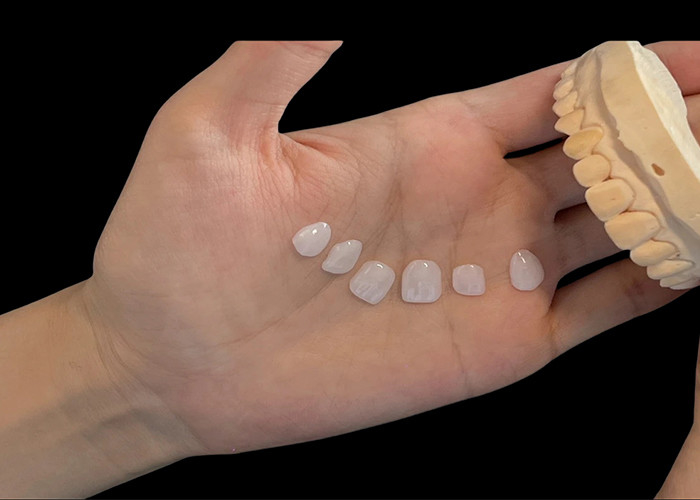 Sombra de porcelana ultra delgada carillas EMAX resistentes a las manchas para restauraciones estéticas