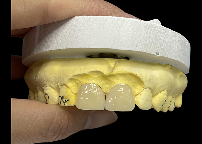Sombra de porcelana ultra delgada carillas EMAX resistentes a las manchas para restauraciones estéticas