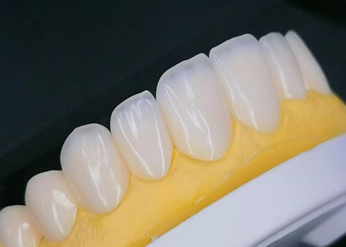Veneer de porcelana EMAX con resistencia a las manchas para restauraciones estéticas de aspecto natural