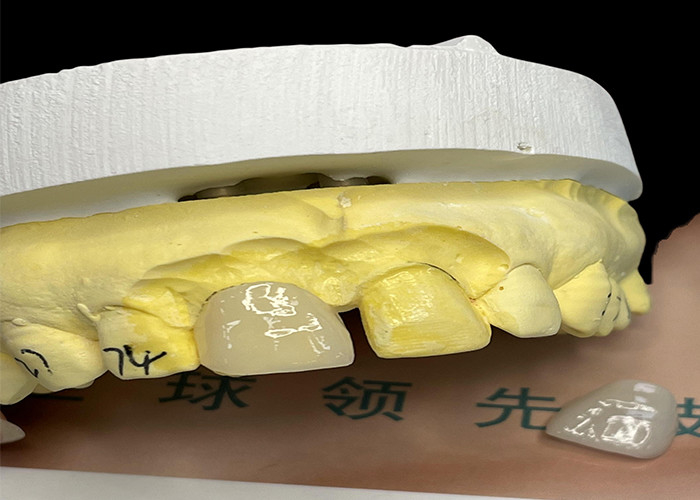 Veneer de porcelana EMAX con resistencia a las manchas para restauraciones estéticas de aspecto natural