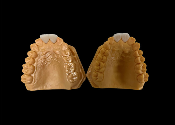 Corona dental de zirconia estética personalizada perfectamente ajustada para los dientes anteriores y posteriores
