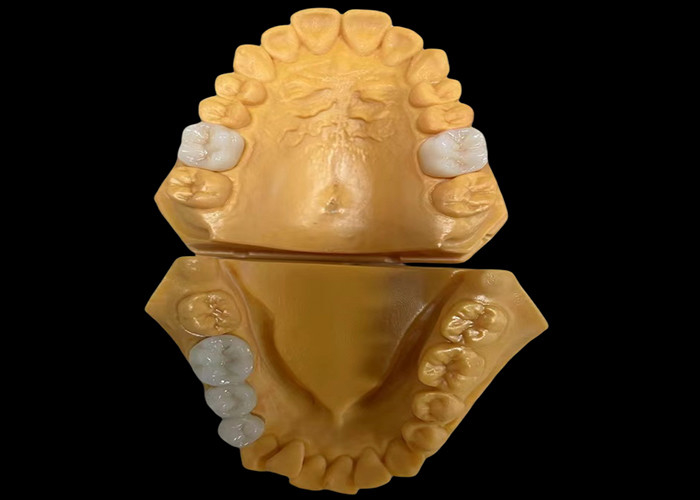 Corona dental de zirconia estética personalizada perfectamente ajustada para los dientes anteriores y posteriores