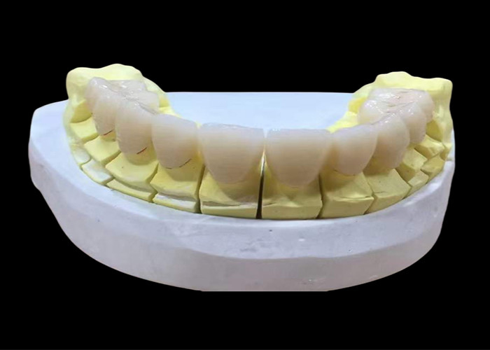 Corona dental de porcelana de zirconia con acabado estético y de aspecto natural de laboratorio dental de China