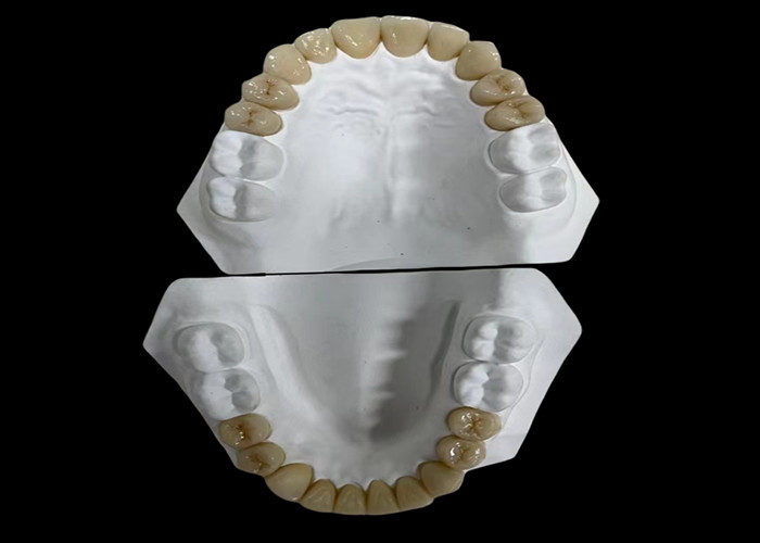 Puente dental de porcelana cómodo con construcción totalmente cerámica para una resistencia excepcional al desgaste