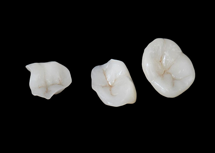 Inlays y onlays de cerámica biocompatibles diseñados para una durabilidad confortable e integración perfecta con los dientes naturales