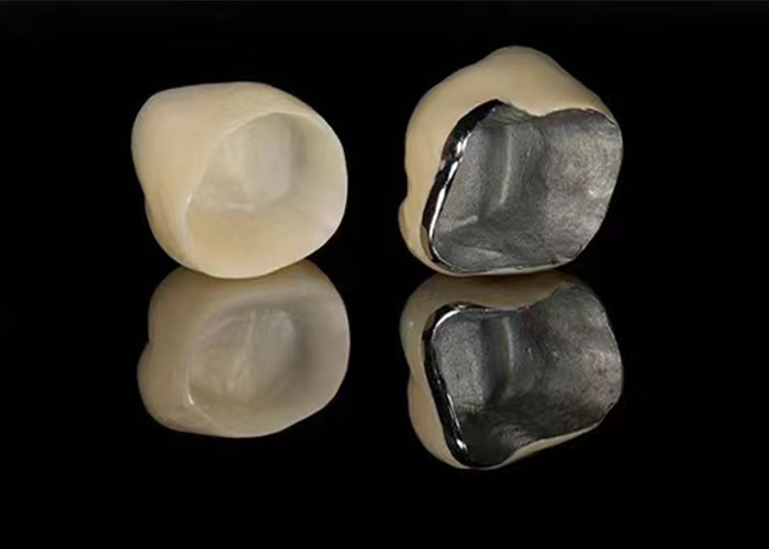 Porcelana de aspecto natural fundida con corona de metal para restaurar los dientes dañados