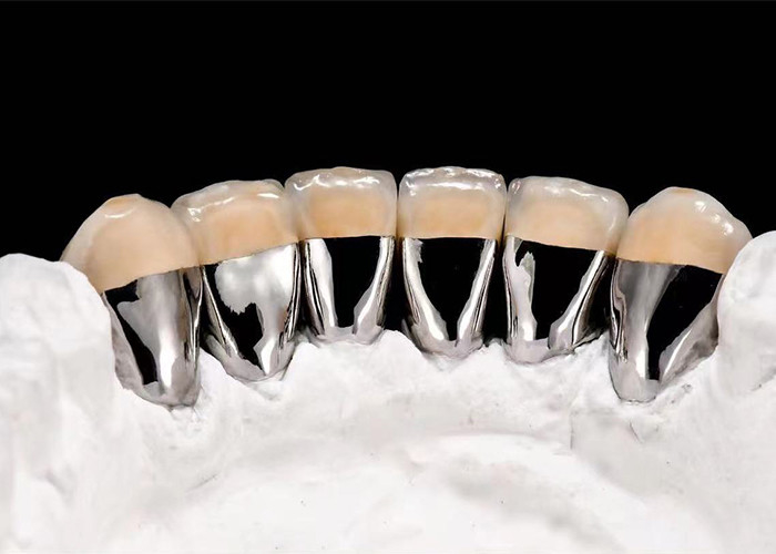 Porcelana de aspecto natural fundida con corona de metal para restaurar los dientes dañados