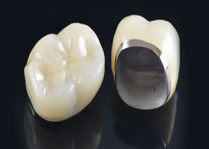 Porcelana de aspecto natural fundida con corona de metal para restaurar los dientes dañados