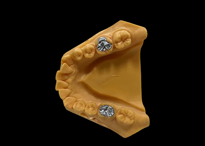 Porcelana fundida con metal PFM Corona Dental Resistencia al desgaste para odontología restaurativa
