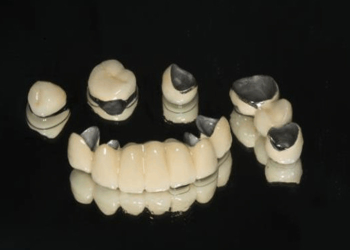 Porcelana fundida con metal PFM Corona Dental Resistencia al desgaste para odontología restaurativa