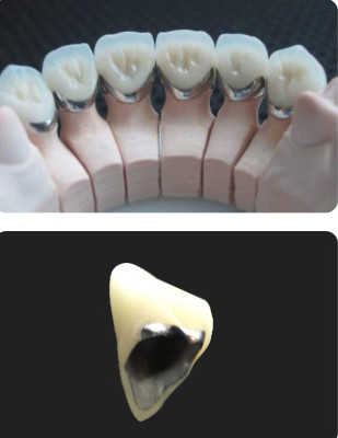 Porcelana fundida con metal PFM Corona Dental Resistencia al desgaste para odontología restaurativa
