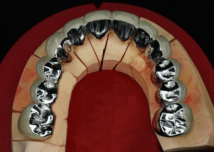 Porcelana de restauración de alta durabilidad fundida con corona de metal para una sonrisa de aspecto natural
