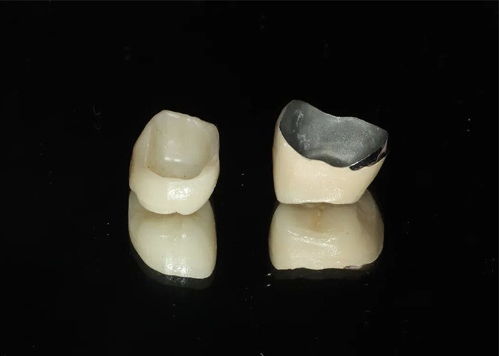 Porcelana de restauración de alta durabilidad fundida con corona de metal para una sonrisa de aspecto natural